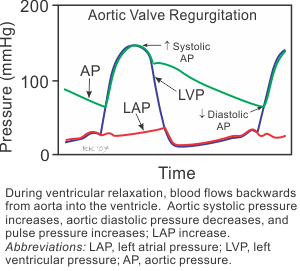 valv ar HD005 aortic regurgitation